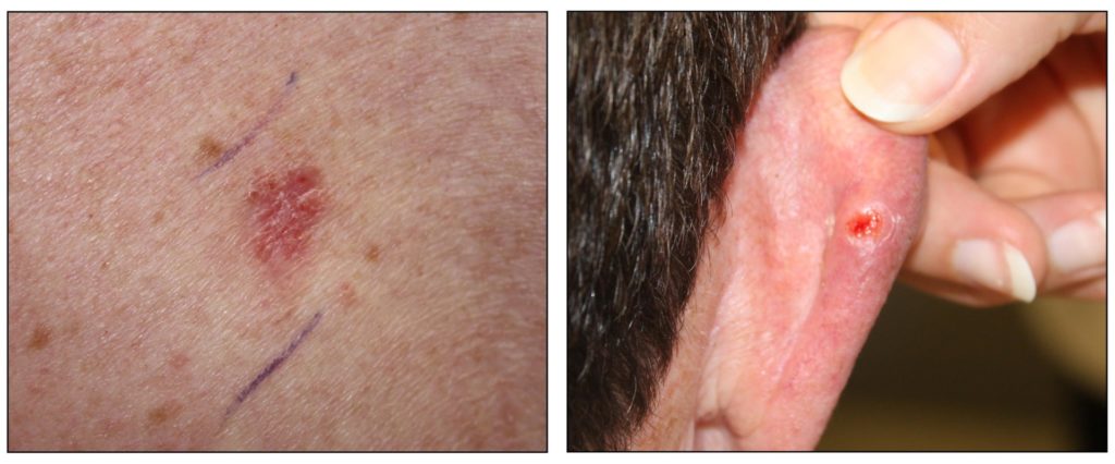 Treating Basal and Squamous Cell Skin Cancer