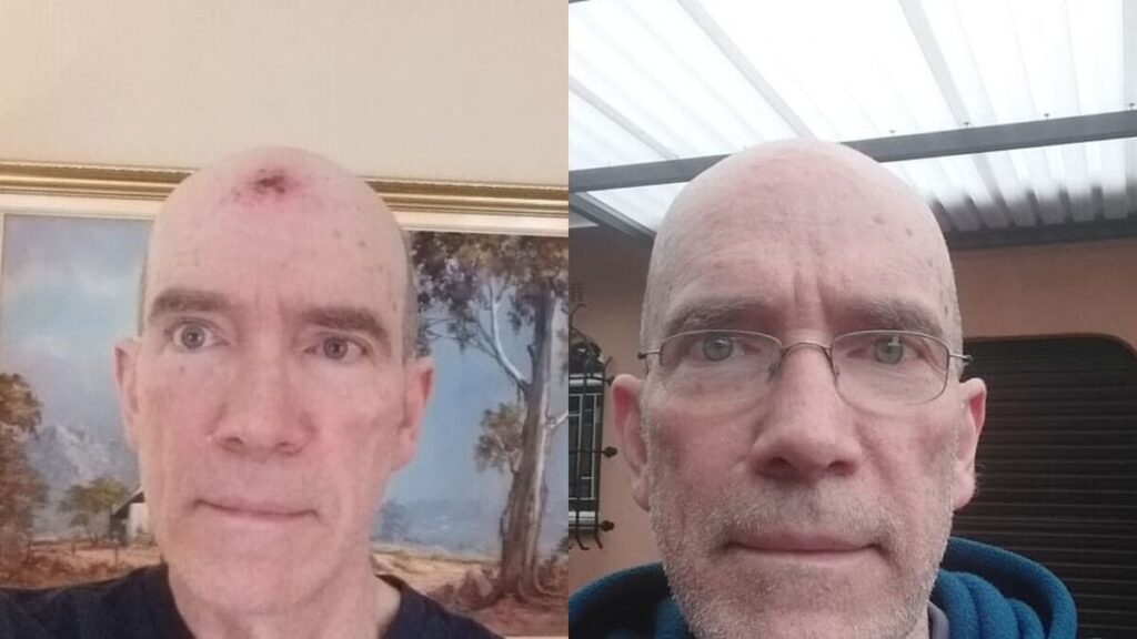Beating Skin Cancer - How did I get it and how it was treated