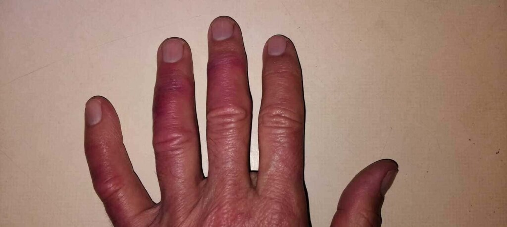 Chilblains - a Few Notes